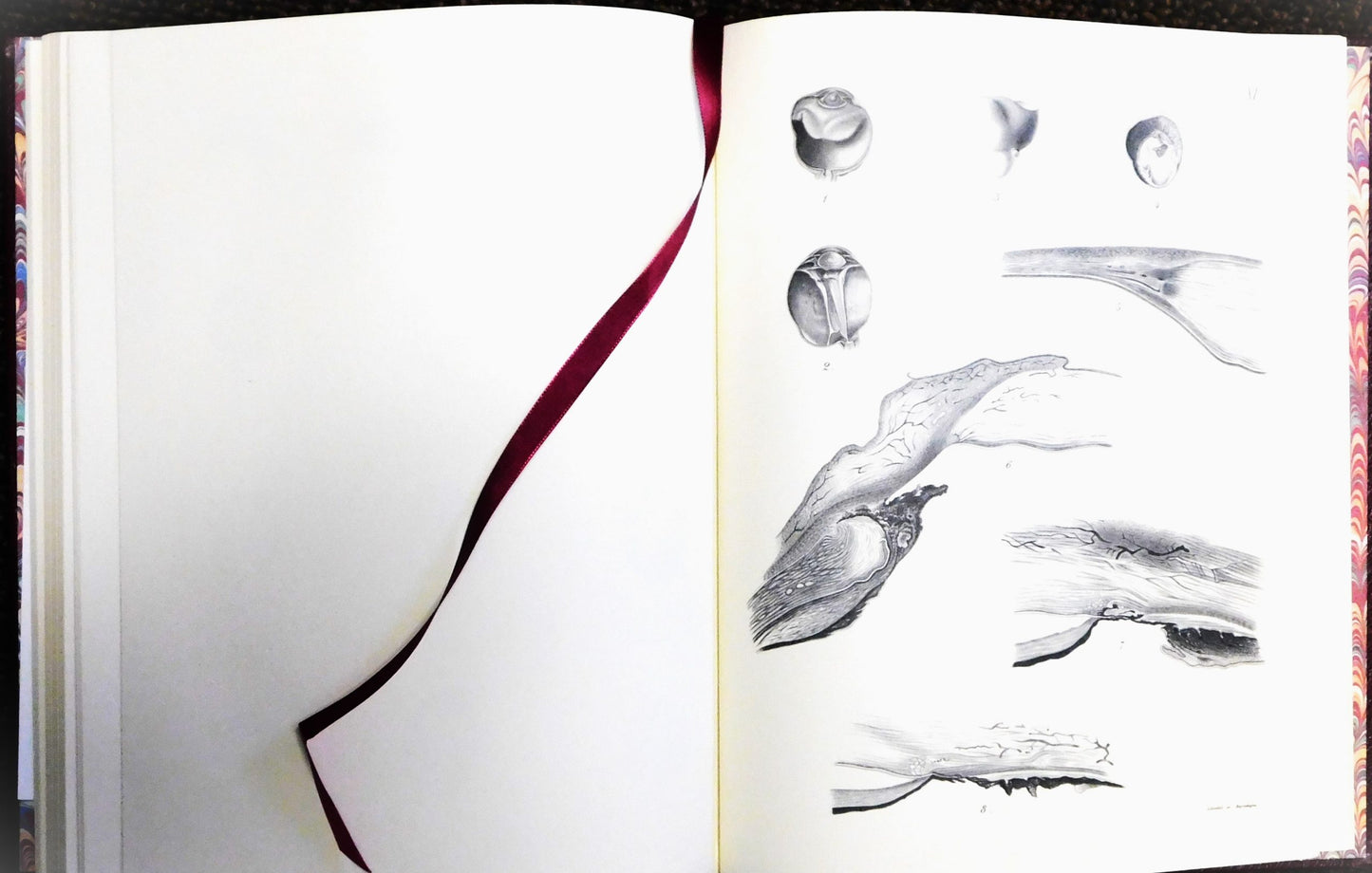 Atlas of the Pathological Anatomy of the Eyeball by Pagenstecher and Genth