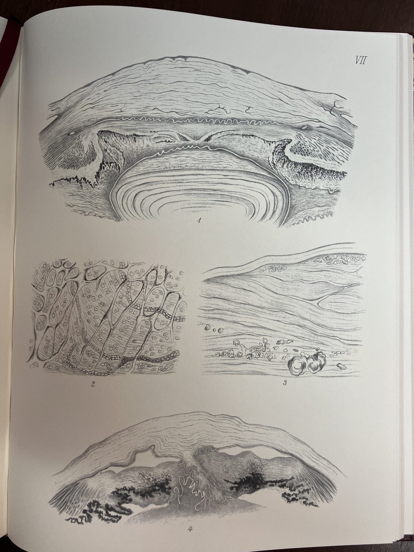 Atlas of the Pathological Anatomy of the Eyeball by Pagenstecher and Genth